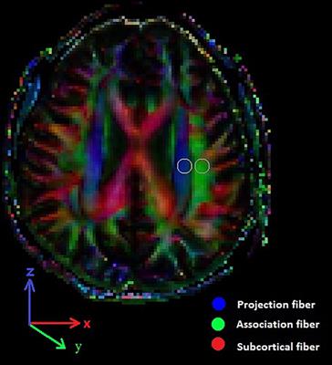 Diffusion Tensor Imaging Along the Perivascular Space Index in Different Stages of Parkinson’s Disease